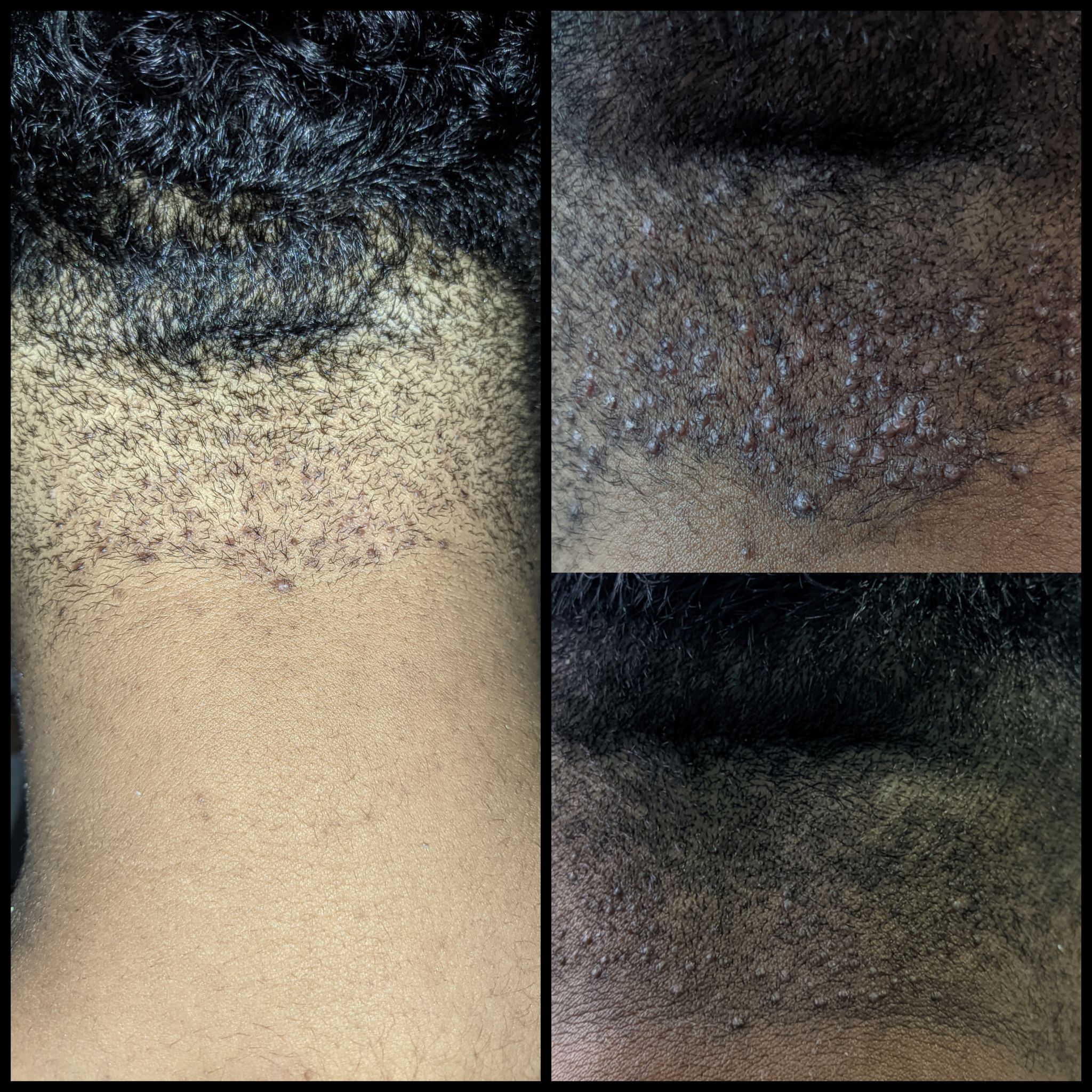 Resultado Tend Skin — foliculite tratada com antes e depois lado a lado